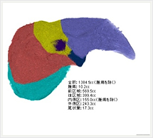 肝臓区域切除シミュレーション3D画像