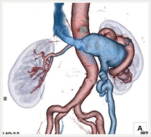 腎動脈、腎静脈奇形3D画像