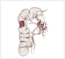 腫瘍栄養血管+大腸3D画像
