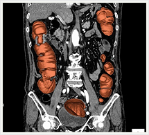 大腸3D+多断面画像（前額断）