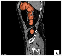 大腸3D+多断面画像（矢状断）