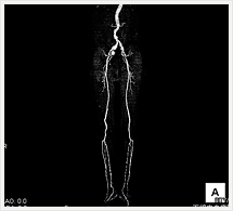 大動脈～下肢動脈3D画像