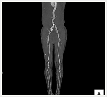 大動脈～下肢動脈3D画像