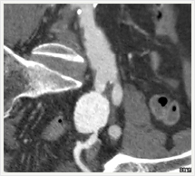 鼠径部動脈瘤の多断面画像画像
