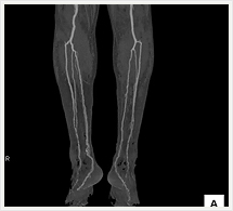 下肢動脈3D画像