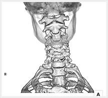 頸椎3D画像（正面像）