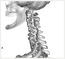 頸椎3D画像（側面像）