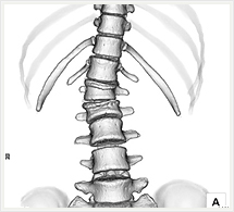 腰椎3D画像（正面像）