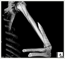 上腕骨骨折3D画像