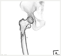 股関節骨折3D画像
（骨盤骨半透明）