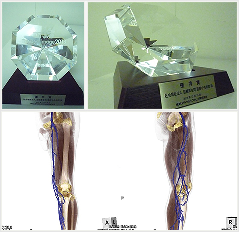 画論 優秀賞 受賞画像：単純撮影 下肢静脈瘤の3D画像