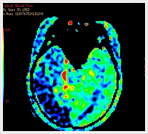 非造影パーヒュージョン