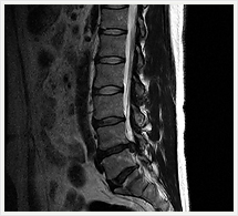 腰椎椎間板ヘルニア T2矢状断