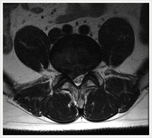 腰椎椎間板ヘルニアT2水平断