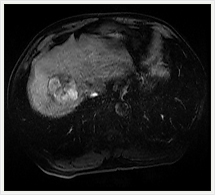 ダイナミック動脈相