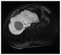 造影剤注入15分後
