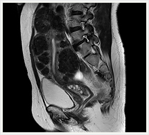 子宮筋腫 T2矢状断