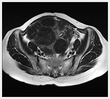子宮筋腫 T2水平断