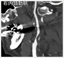 頚動脈多断面画像