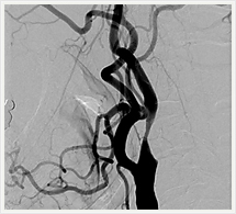 治療前頚動脈血管撮影画像