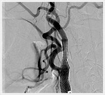 治療後頚動脈血管撮影画像