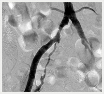 治療前下肢血管造影