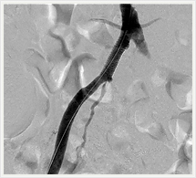 治療後下肢血管造影