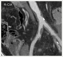治療前CT多断面画像