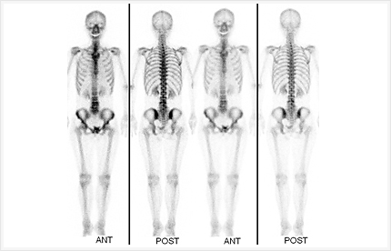 骨シンチグラフィ