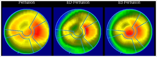 安静時心筋血流シンチグラフィ画像