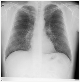 胸部レントゲン写真