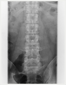 腰椎レントゲン写真