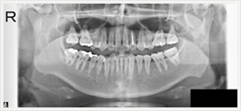 顎部パノラマ写真 (レントゲン)