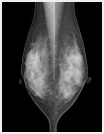 レントゲン写真