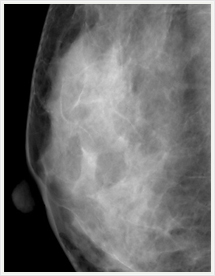 レントゲン写真