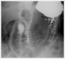 胃バリウム造影検査