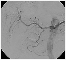 血管連続撮影検査