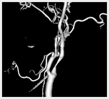 頚部血管3D画像