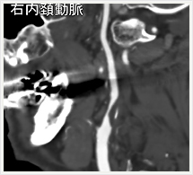 頚部血管多断面画像