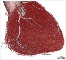 右冠状動脈3D画像
