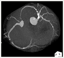 左冠状動脈3D画像
