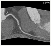 右冠状動脈多断面画像