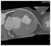 左冠状動脈多断面画像