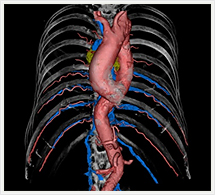 胸部大動脈3D画像