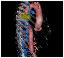 胸部大動脈3D画像