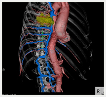 胸部大動脈3D画像