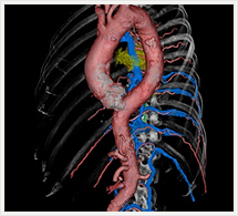 胸部大動脈3D画像