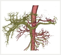 腹部動脈血管、門脈3D画像