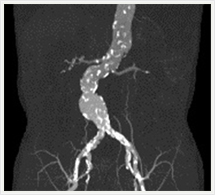 ステントグラフト術前CT