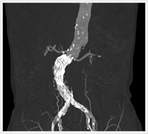 左冠状動脈治療前